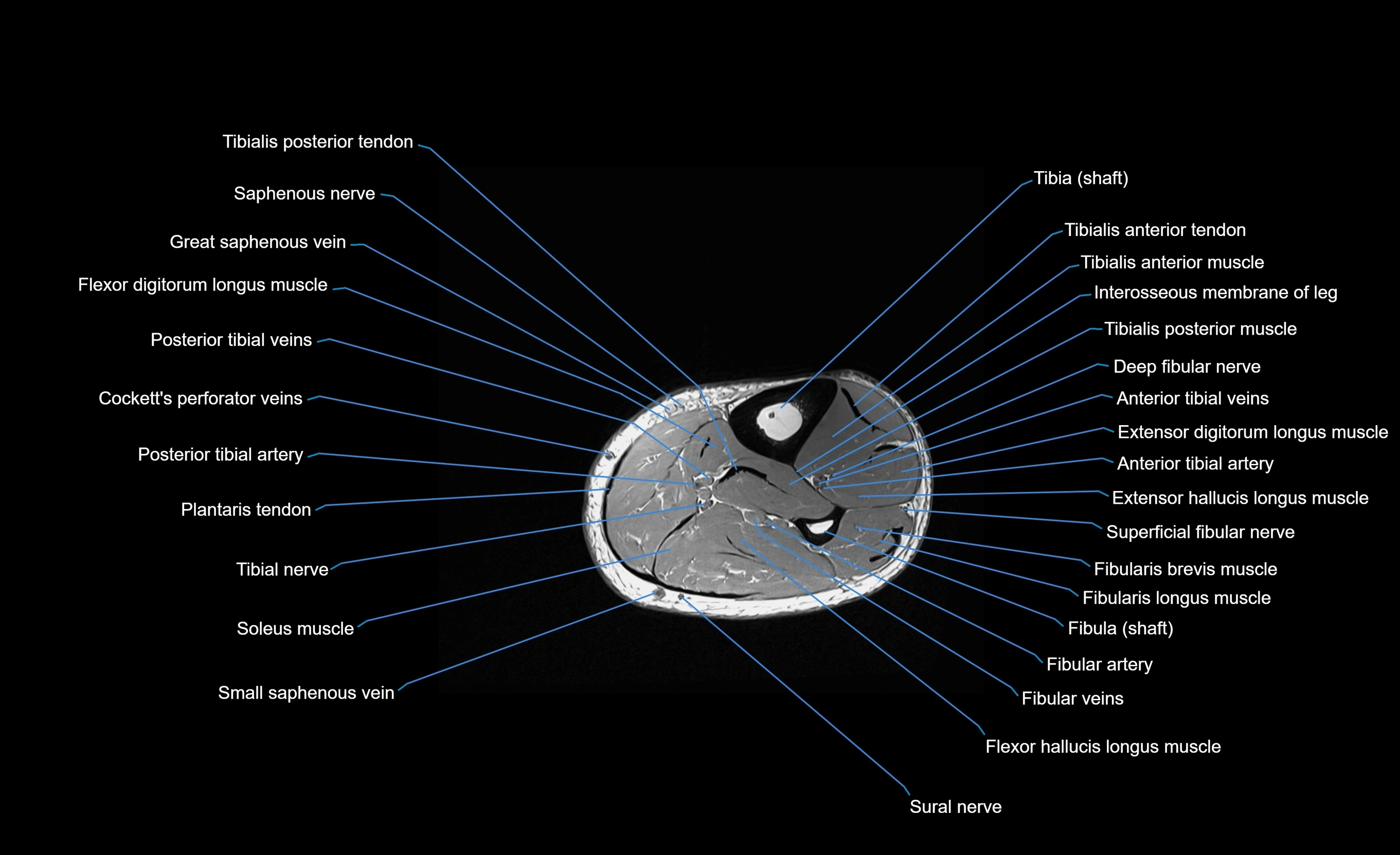 MRI lower leg axial cross sectional anatomy 3T  radiology  image-img-00001-00061.webp